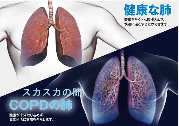 甲状腺機能亢進症/バセドウ病とCOPD(慢性閉塞性肺疾患;慢性気管支炎、肺気腫) 甲状腺機能亢進症/バセドウ病とCOPD(慢性閉塞性肺疾患;慢性気管支炎、肺気腫)